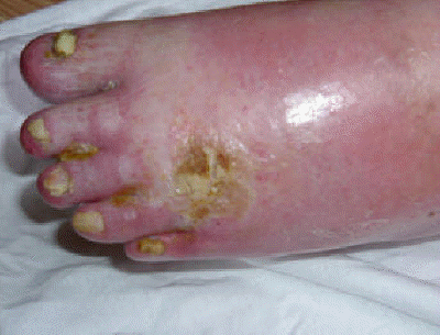 db_RSD_Infection_Pic_-1_copy1